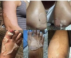 Super Extra Strong Whitening Dark Knuckles Peeling Exfoliating Oil, Stubborn (1)