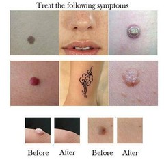 1Set(6Pcs) Replace Cartridges for Fibroblast Plasma pen Spot Mole Tattoo Remover