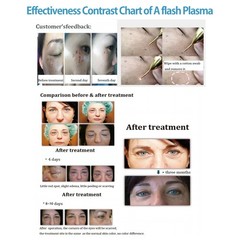 2in1 Plasma Ozone Eyelid Lift Pen Machine Acne Treatment Skin Care Beauty Device