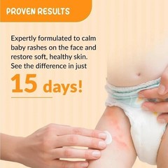 FIX derMA Hoopoe Anti Rash Face Cream for Face , Calms Redness, Rashes Q433