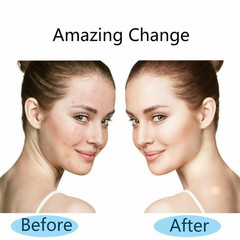 Derma Roller for Hair Loss Beard Growth 0.5-2.0mm Microneedle Dermaroller US