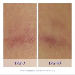 Is Clinical Super Serum Advance Anti-Aging Vitamin C Face Serum Reduces Scaring