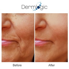 Anti Aging Resurfacing Peel Pads- Triple Action Chemical Peel Pads.