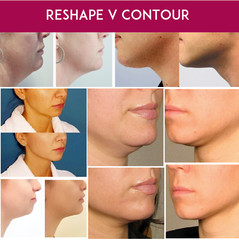 Double Chin Remover Face Lifting Firming Shaping Vela Contour 5 patches, masks