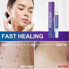 5*5ml Warts Removal Pen Eliminate Wart Pen Wart Liquid Hand Foot Warts Remove