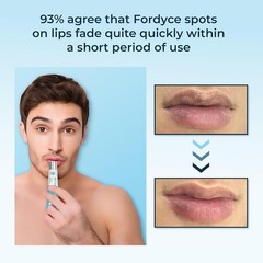 Belani Fordyce Cream – Helps Reduce Fordyce Spots & Hydrate Dry, Chapped, Dar…