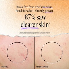 Derma E Acne Deep Pore Cleansing Wash – Blemish 6 Fl Oz (Pack of 1), WHITE