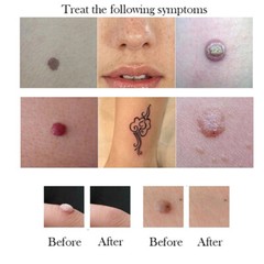 Beauty Monster Plasma Pen Fibroblast Eyelid Lift Freckle Scar Dark Spot Removal