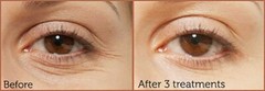 HYALURONIC ACID 100% Pure Anti Aging Hydrating Serum, Plumps Wrinkles Fine Lines