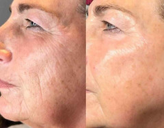 2 Pk – Matrixyl 3000, Argireline Hyaluronic Acid AntiAging Wrinkle SERUM + CREAM