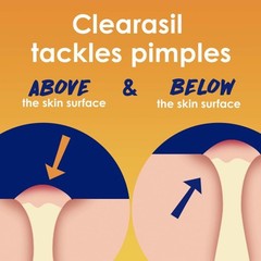 Clearasil Stubborn Acne Control 5in1 6.76 Fl Oz (Pack of 1), White