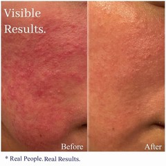 Dermatologist-Tested Rosacea Cream – Hydrating Relief for Facial Redness
