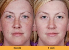 DARK SKIN WHITENING LIGHTENING ULTRA BRIGHTENING SERUM Dark Spot Bleaching Cream