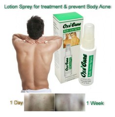 2 Oxe Cure Body Spray Reduce Blemish Treatment Acne on Back Chest Neck Skin 25ml