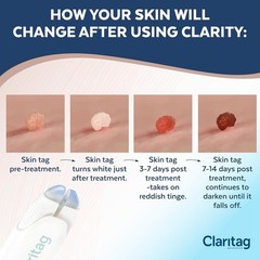 Advanced Cryogenic Skin Tag Removal Kit – 10 Treatments, Results in 7-14 Days