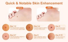 3-in-1 Auto Skin Tag Remover Pen Tool Kit Painless Wart Skin Tag Removal 1-8 mm