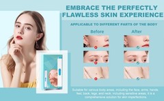 Painless Skin Tag Remover Device Kit Auto Safe Removal 1-9 MM Band Tool Home Use