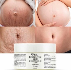 Stretch Marks and Scars Removal Cream for Pregnancy