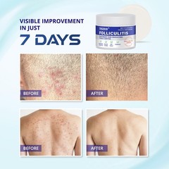 TAGRID Folliculitis Cream, Ingrown Hair, Soothing Scalp, Face & Body Cream – Hyd