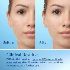 Acne Treatment Gel, 30 Day Supply, Retinoid Treatment for Face with 0.1% Adapale