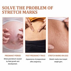 Stretch Marks and Scars Removal Cream for Pregnancy