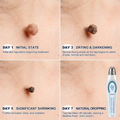7-Day Skin Tag & Spot Eraser Roll-On Botanical Spot Corrector Liquid 15ml