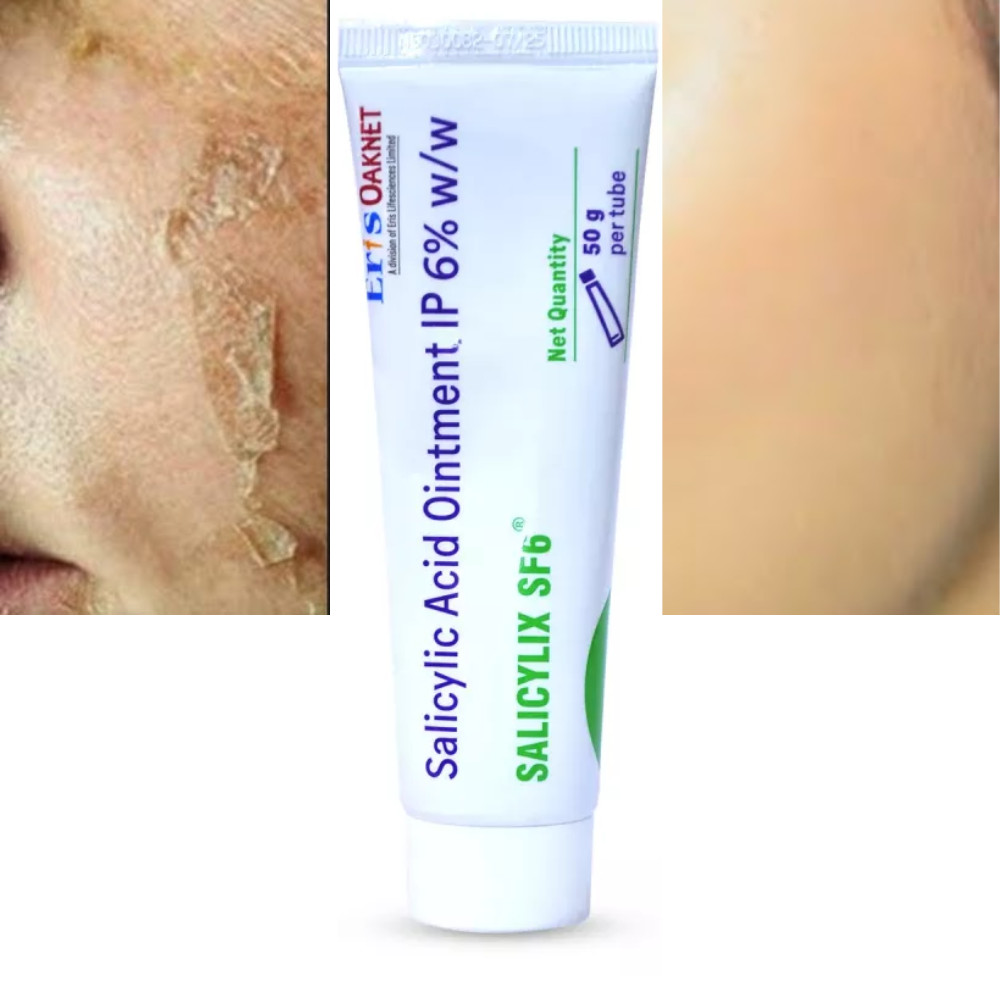 Oaknet Salicylic Acid SF6 Ointment Firming&Moisturizer cream for Unisex
