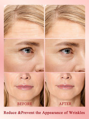 Radio Frequency Skin Tightening Device, Anti-Aging Face Machine, Wrinkle