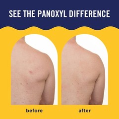 PanOxyl Acne Banishing Body Spray with 2% 6 Ounce (Pack of 1), White