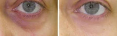 Eye Serum