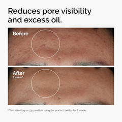 Niacinamide 10% Zinc 1% Face Serum for Blemish Prone Skin