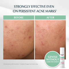 EUCERIN Pro Acne Solution Triple Effect 40ml