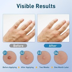 5X 5ml Warts Removal Pen Eliminate Wart Pen Wart Liquid Hand Foot Warts Remove
