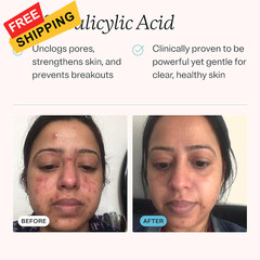 MDacne Hydrating Facial Cleanser with Salicylic Acid 0.5% 2 Ounce (Pack of 1)