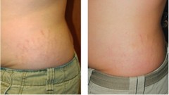Anti Cellulite Massage Oil-Tones Skin & Helps Shrinks Stretchmarks By Chakra
