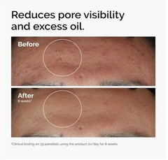 The Ordinary Niacinamide 10% + Zinc 1%, Smoothing Serum for Blemish-Prone Skin