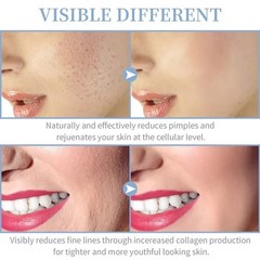Professional Facial Skin Care Wand Machine Anti-aging Acne Hair Treatment Set US