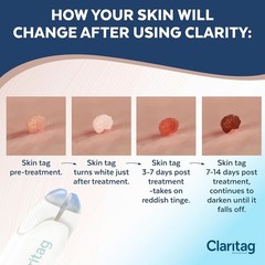 Effective Skin Tag Remover – Cryogenic Freeze-Off – Smooth Skin in 7-14 Days