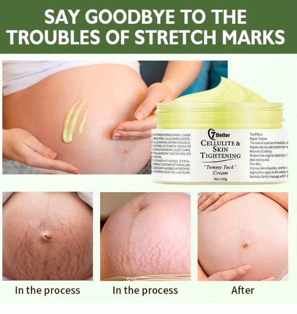 Stretch Marks and Scars Removal Cream for Pregnancy