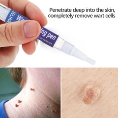 12 Hours Wart Remover Pen Eliminate Foot Corn Warts Skin Tag Remover Woman Man