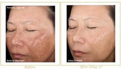 GLYCOLIC ACID 20% CHEMICAL PEEL 1 OZ AHA WRINKLES ACNES BLACKHEADS SKIN FACE