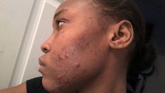 ACNE/ BRIGHTENINGSERUM COMBO