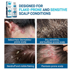Seborrheic Dermatitis & Psoriasis Shampoo – Medicated Dandruff