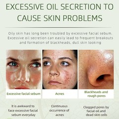 Natural Acne Removal Cream for Oily & Combination Skin | Clears Pimples & Pores