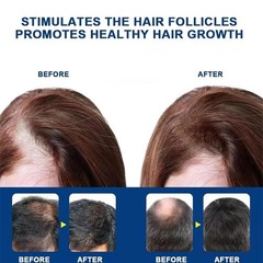 2 pcs Kormesic 5% Hair Growth Scalp Massage Cream Professional Hair Care100g