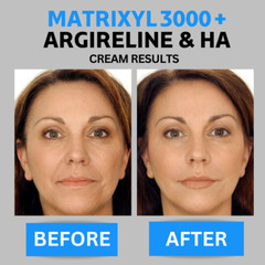 2 Pk – Matrixyl 3000, Argireline Hyaluronic Acid AntiAging Wrinkle SERUM + CREAM