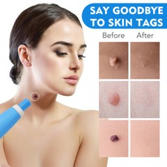 2-8 mm Micro Auto TagBand Skin Tag Remover Device for Small to Medium Skin Tags