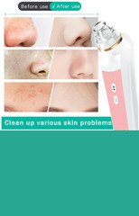 Wireless Visual Blackhead Remover Vacuum – 1080P HD Camera Pore Cleaner – USA
