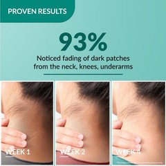 Fixderma Nigrifix Cream For Acanthosis Nigricans For Dark Body Parts 50g