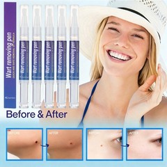 5*5ml Warts Removal Pen Eliminate Wart Pen Wart Liquid Hand Foot Warts Remove